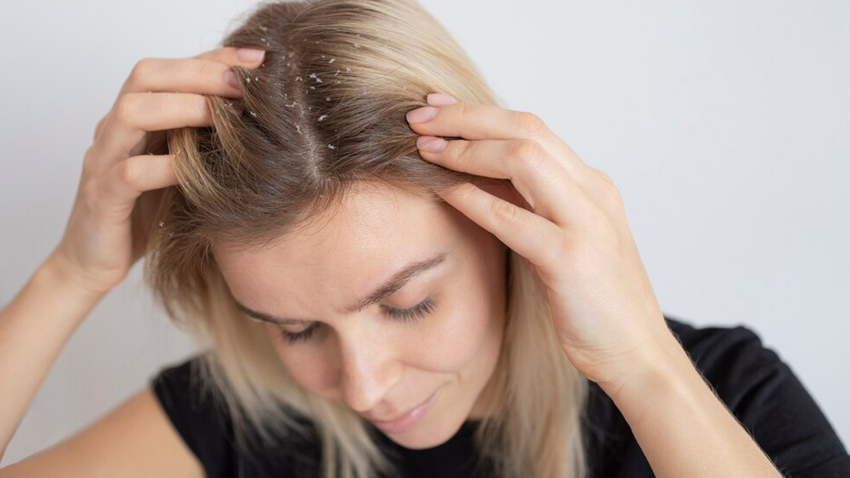 dandruff