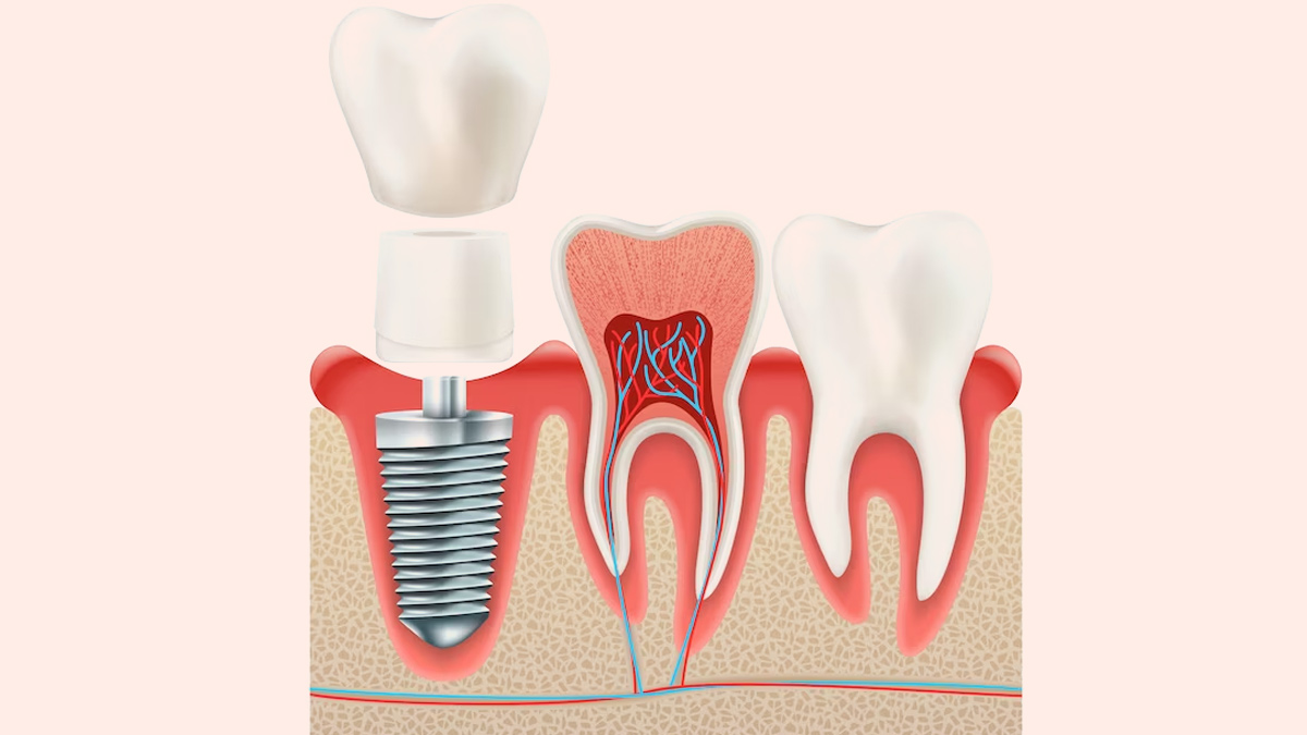 dental-implant