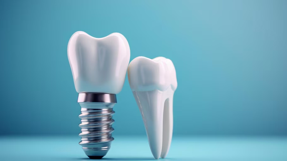 How Long Do Dental Implants Last? Expert Insights On Their Longevity And Key Durability Factors