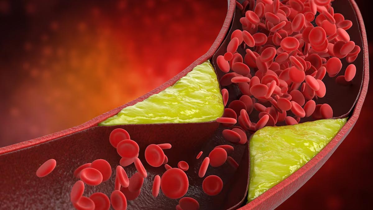 Here’s How Guava Leave Can Help You Manage Cholesterol: Tips To Include It In Your Diet