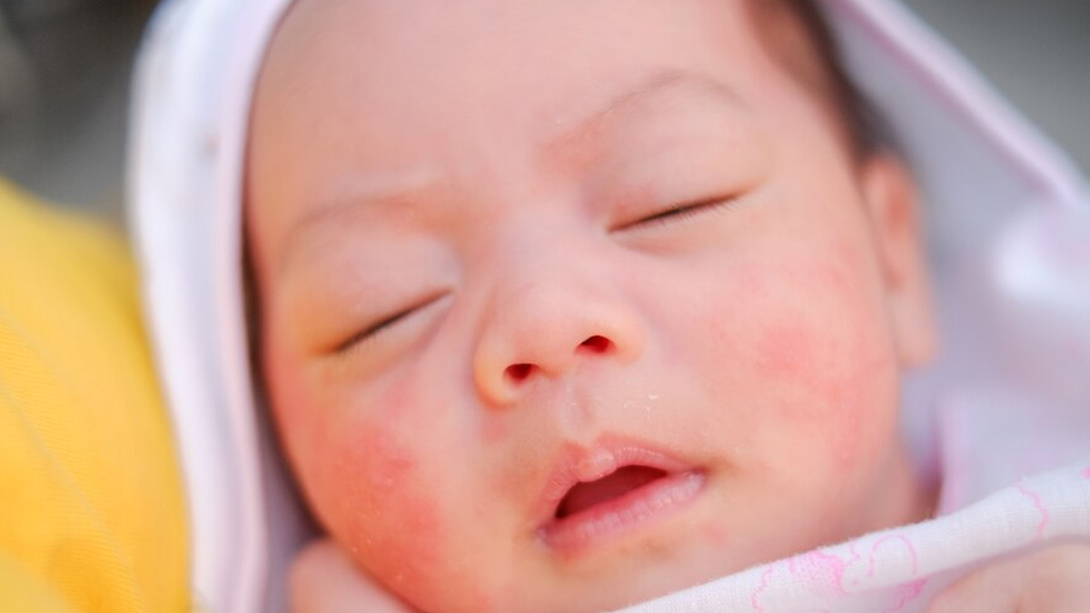baby-rashes