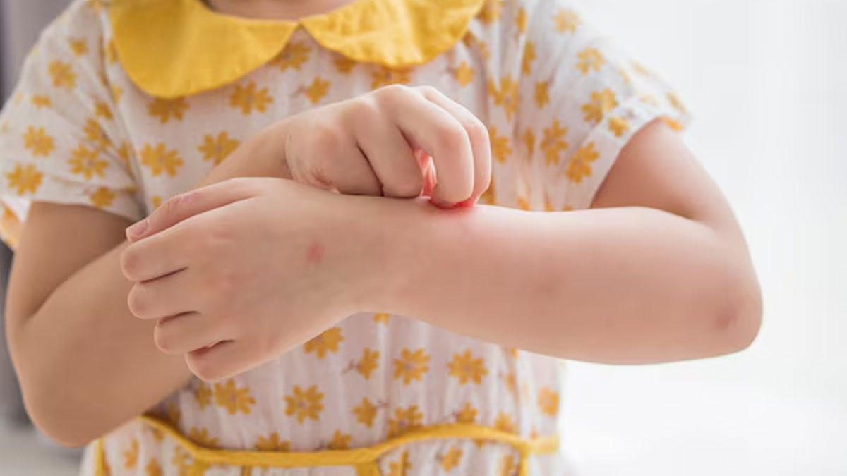 Chikungunya Symptoms In Kids In Hindi