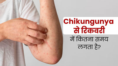 चिकनगुनिया से रिकवरी में कितना समय लगता है? जानें एक्सपर्ट से