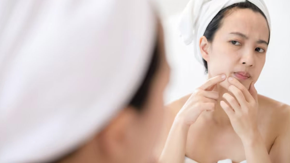 how to prevent acne 