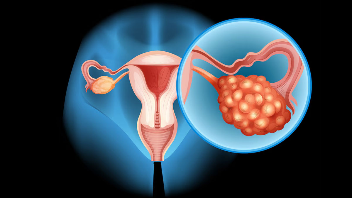 pcos