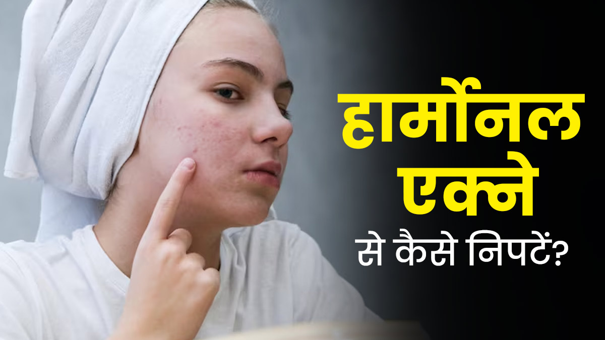 हार्मोनल एक्ने की समस्या कम करने में मदद करेंगे ये टिप्स, चेहरा करेगा ग्लो 