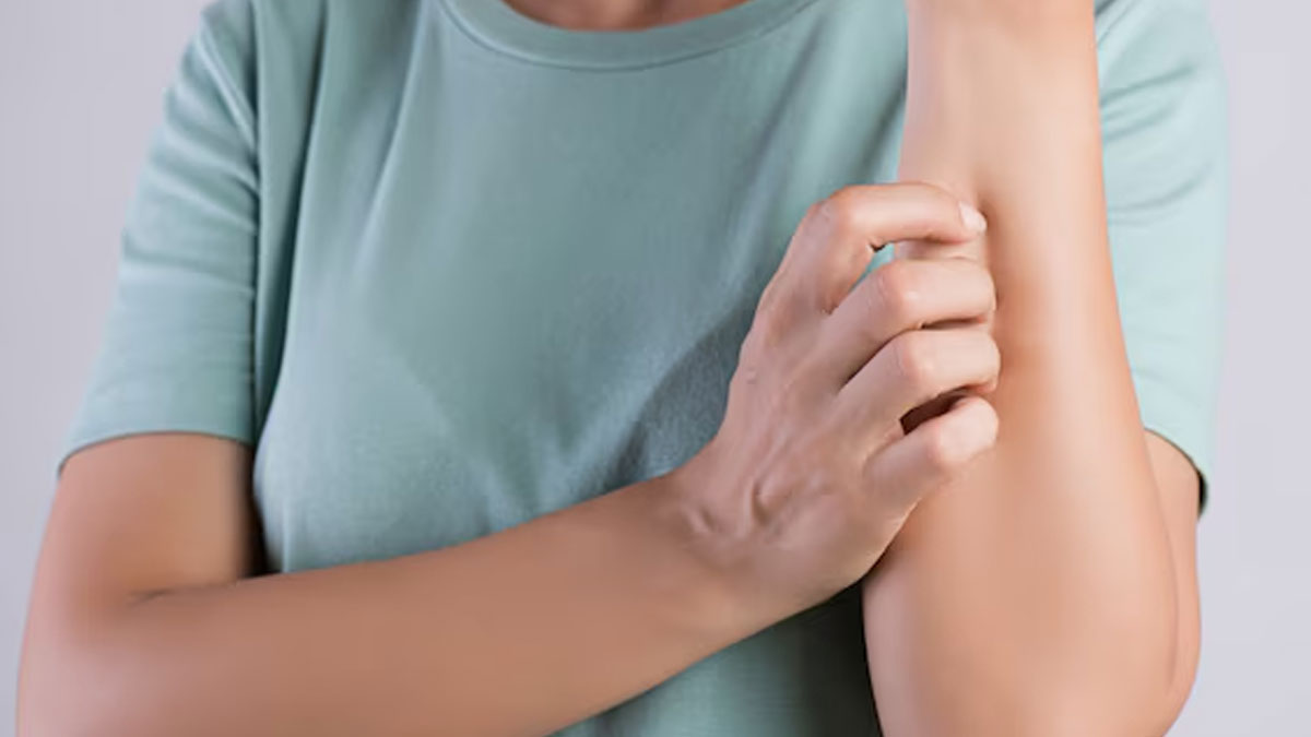 Does Chikungunya Cause Itching And Rashes In Hindi