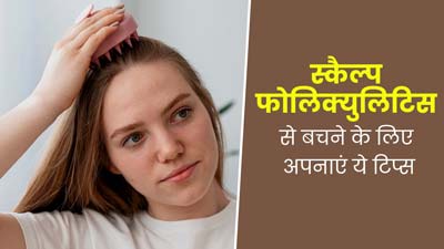 स्कैल्प फॉलिक्युलिटिस (बालों के रोमों में सूजन) से बचने के लिए अपनाएं ये 5 टिप्स, स्कैल्प रहेगा हेल्दी