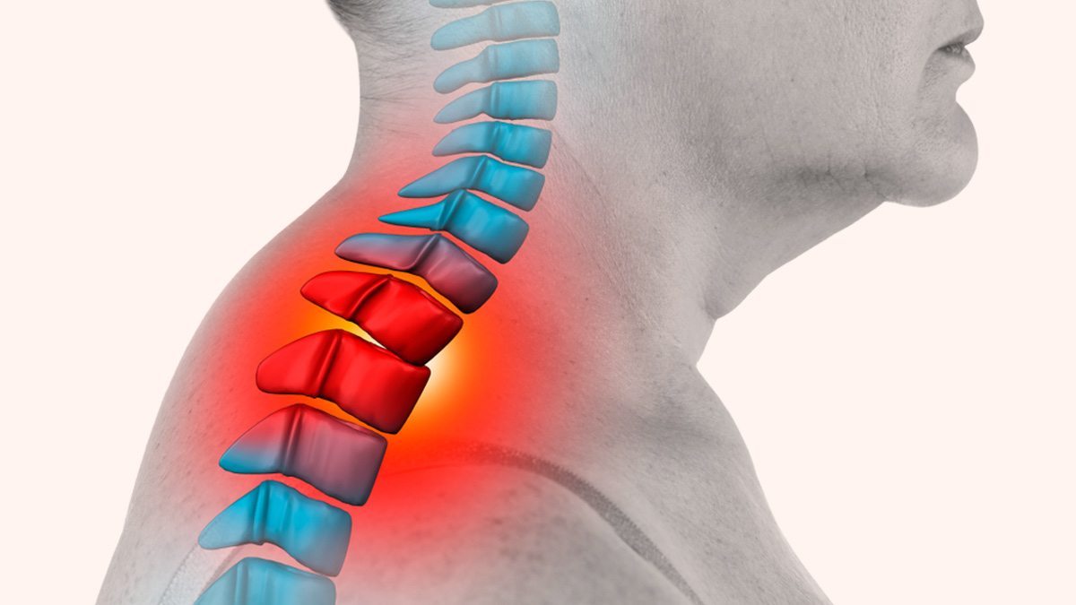 What Causes A Hump In The Back Of Your Neck? These Exercises Can Help Your Reverse It