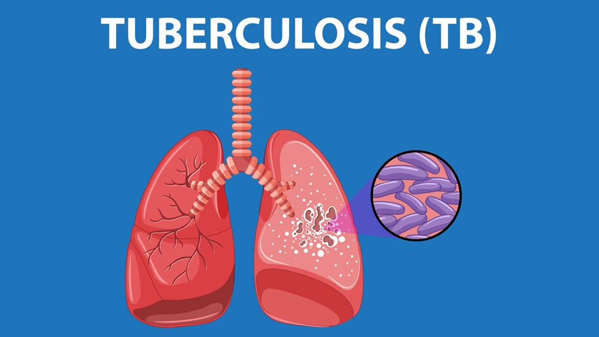 Tuberculosis During Pregnancy: Consequences On Mother And Baby, What ...