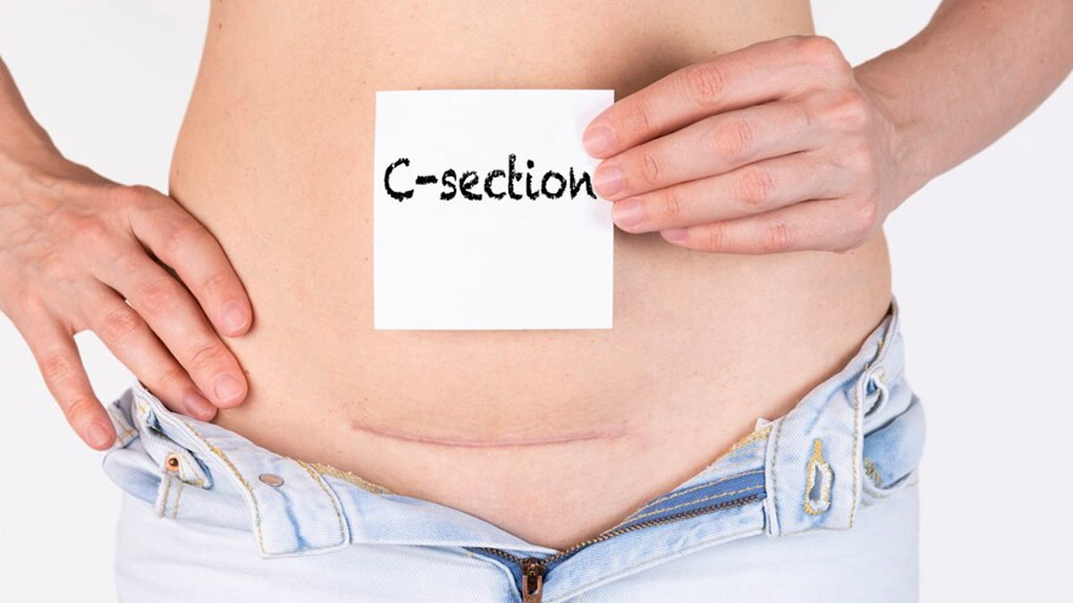 Post-C-Section Care: Do’s And Don’ts To Consider