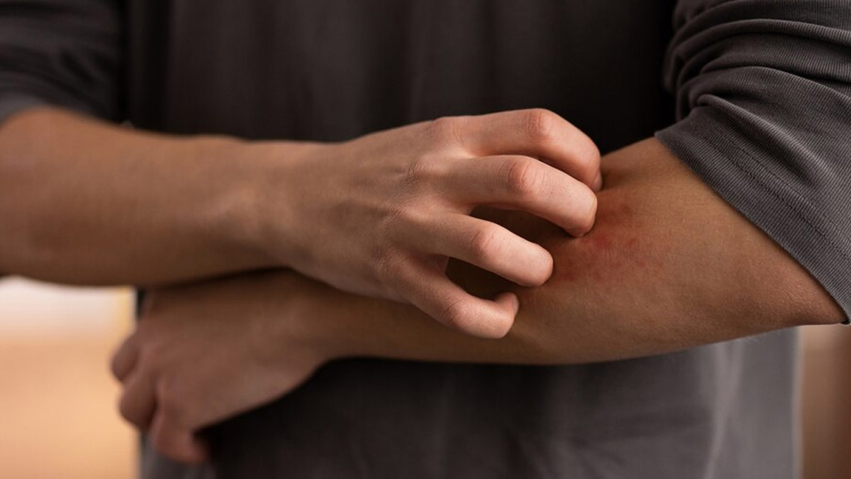 Monsoon Skin Problem: How To Prevent Ringworm Infection From Spreading
