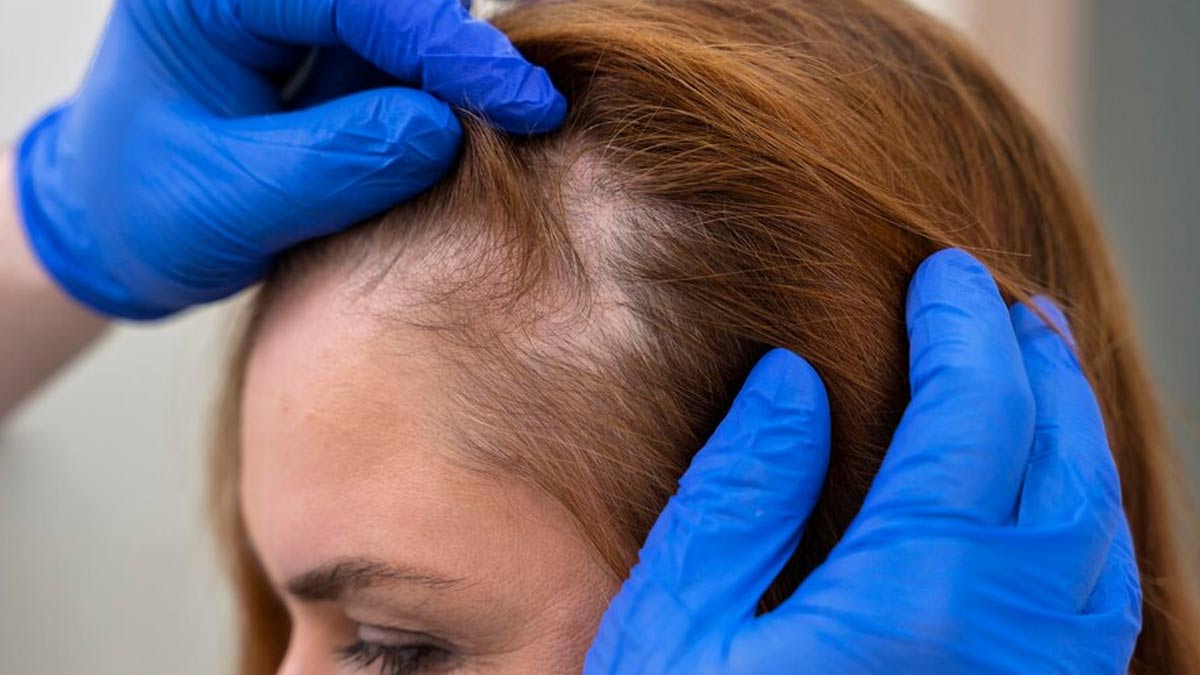 Confused About What’s Causing Your Hair Loss? Turns Out, Vitamin D Could Be The Culprit