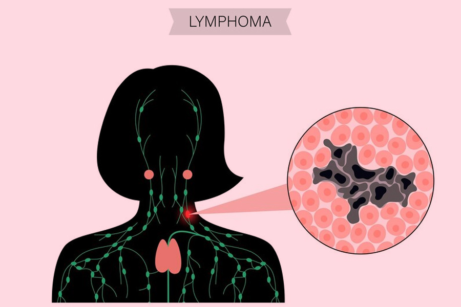 Lymphoma