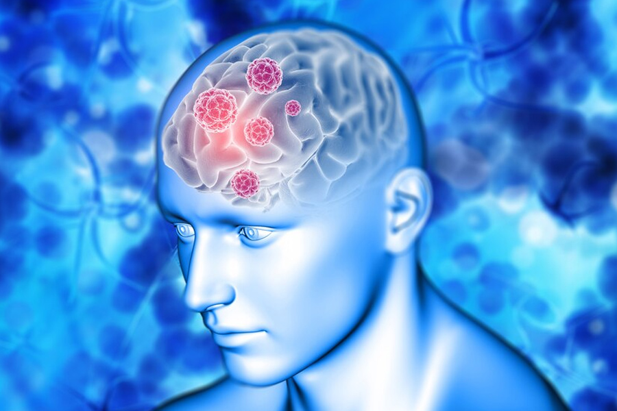 Brain and Central Nervous System Tumours