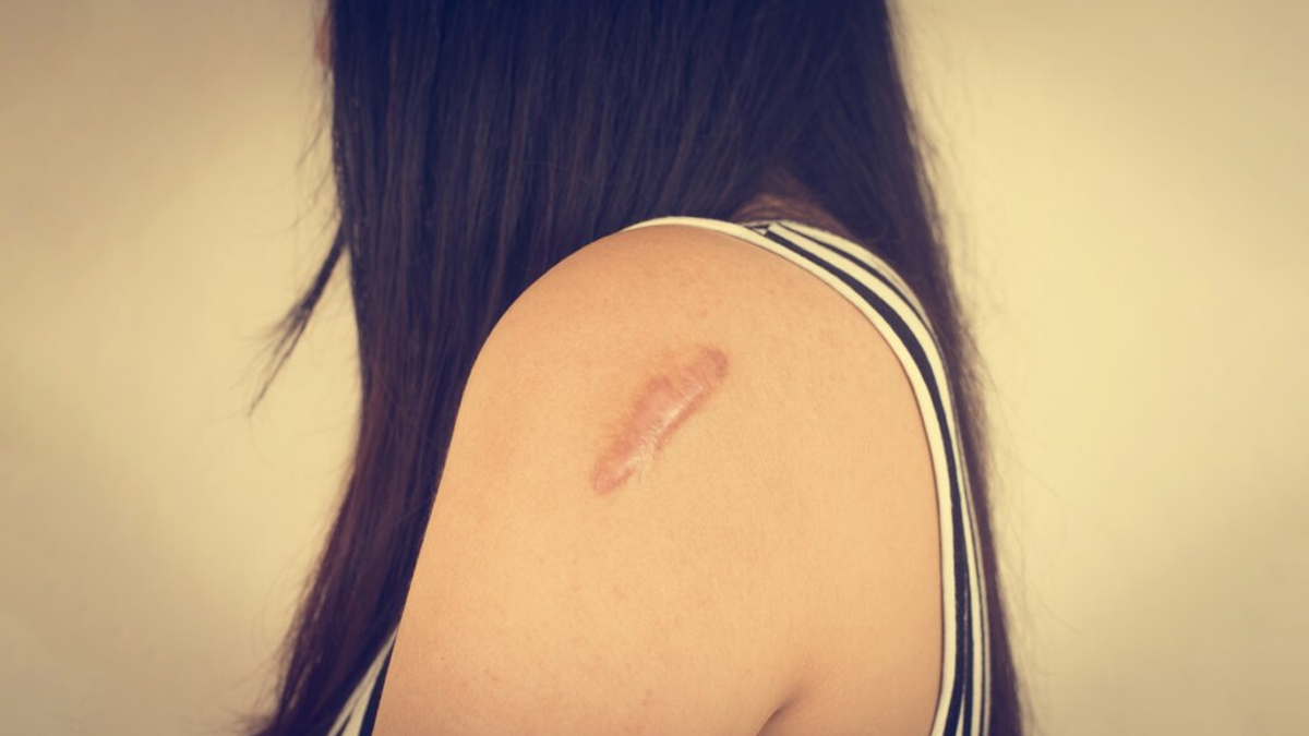 scars