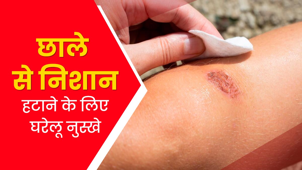 त्वचा से छालों के निशान हटाने के लिए अपनाएं ये 4 घरेलू नुस्खे, मिलेगा फायदा