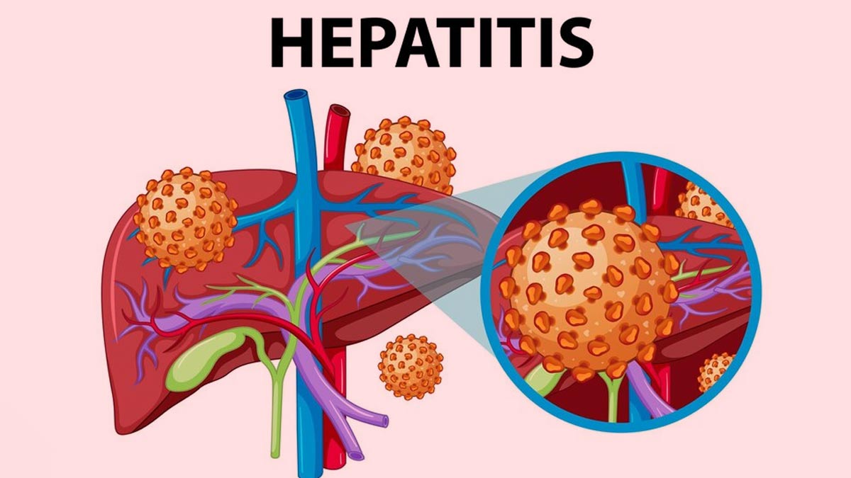 विश्व हेपेटाइटिस दिवस: हेपेटाइटिस के प्रकार और उनके उपचार