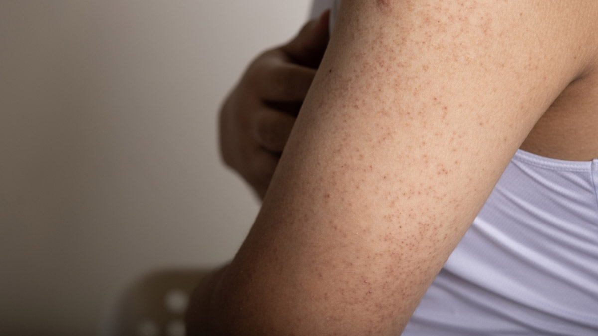 Keratosis Pilaris: Here Are Some Natural Remedies That Can Help Alleviate This Skin Condition