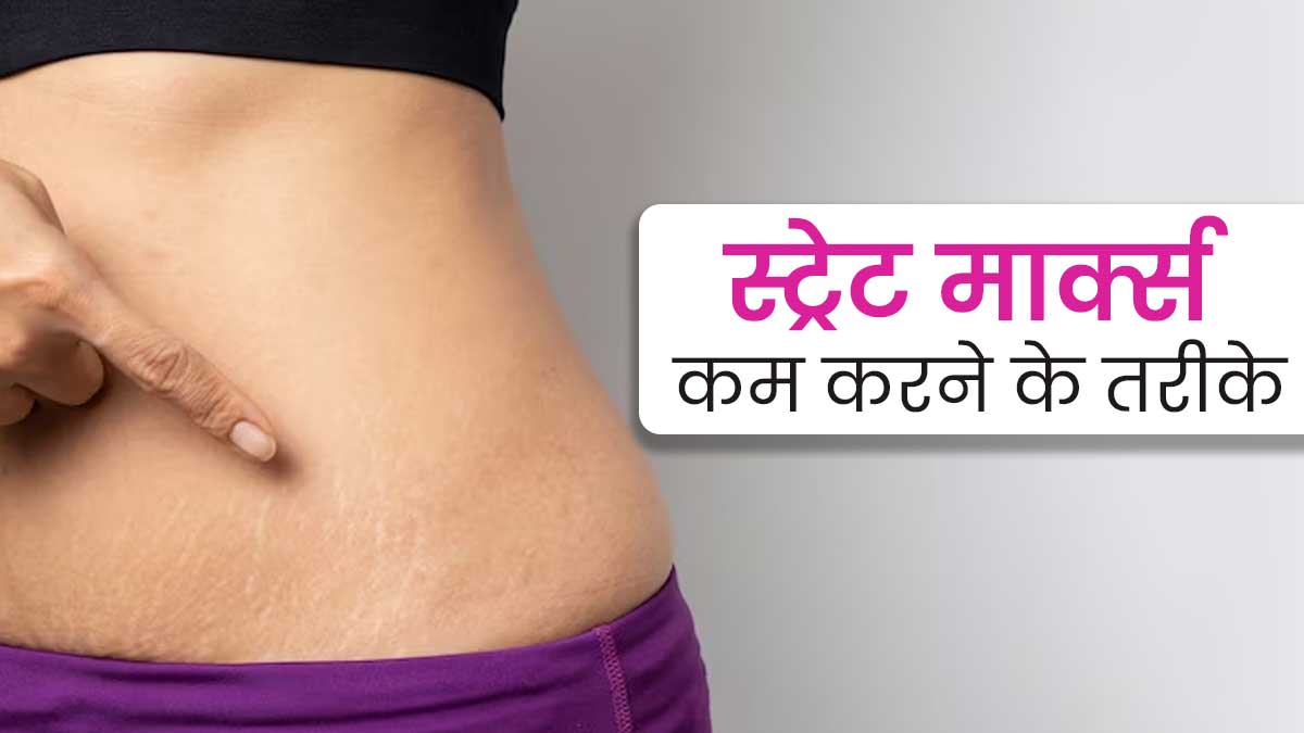 त्वचा पर स्ट्रेच मार्क्स क्यों होते हैं? डॉक्टर से जानें इनसे छुटकारा पाने के टिप्स