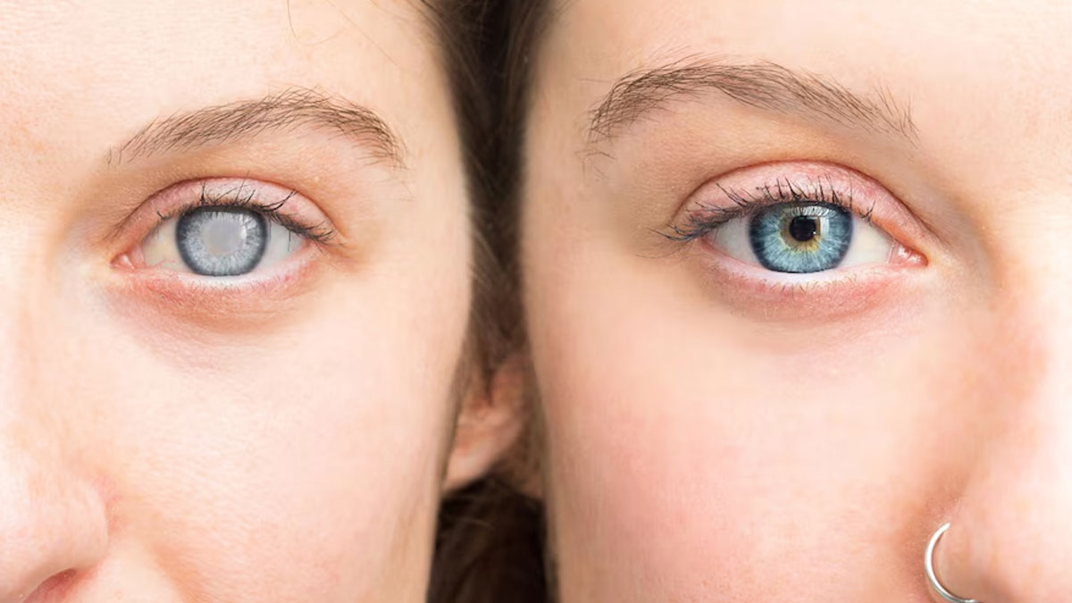 Cataracts Vs Glaucoma: Doctor Explains The Difference Between The Two Eye Conditions