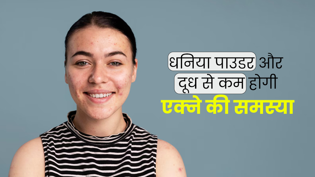 एक्ने पर लगाएं धनिया पाउडर और दूध का मिश्रण, दूर होगी समस्या