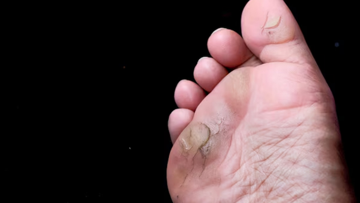 Is A Diabetic Foot Ulcer Dangerous In Hindi