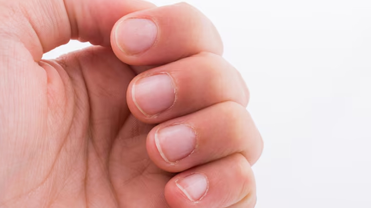 yellow nail syndrome causes and symptoms
