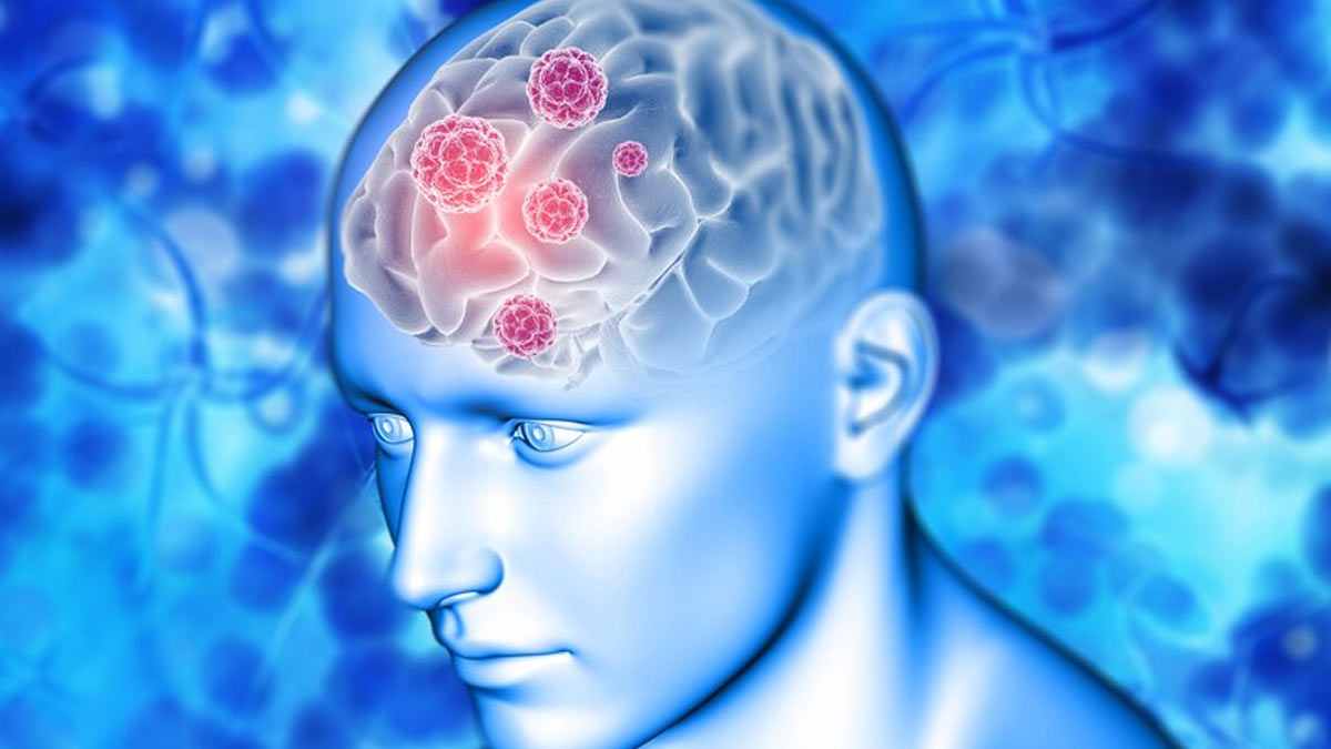 Glioblastoma Vs Other Brain Tumours: Expert Explains Their Similarities And Differences