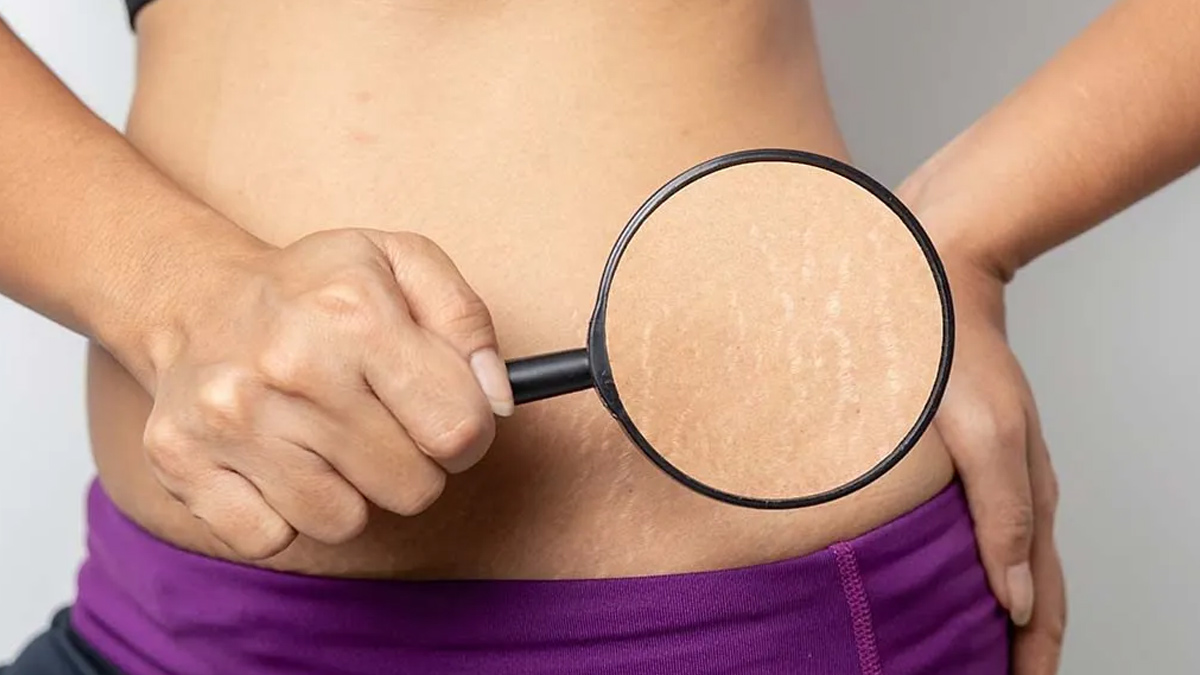 stretch marks in pregnancy