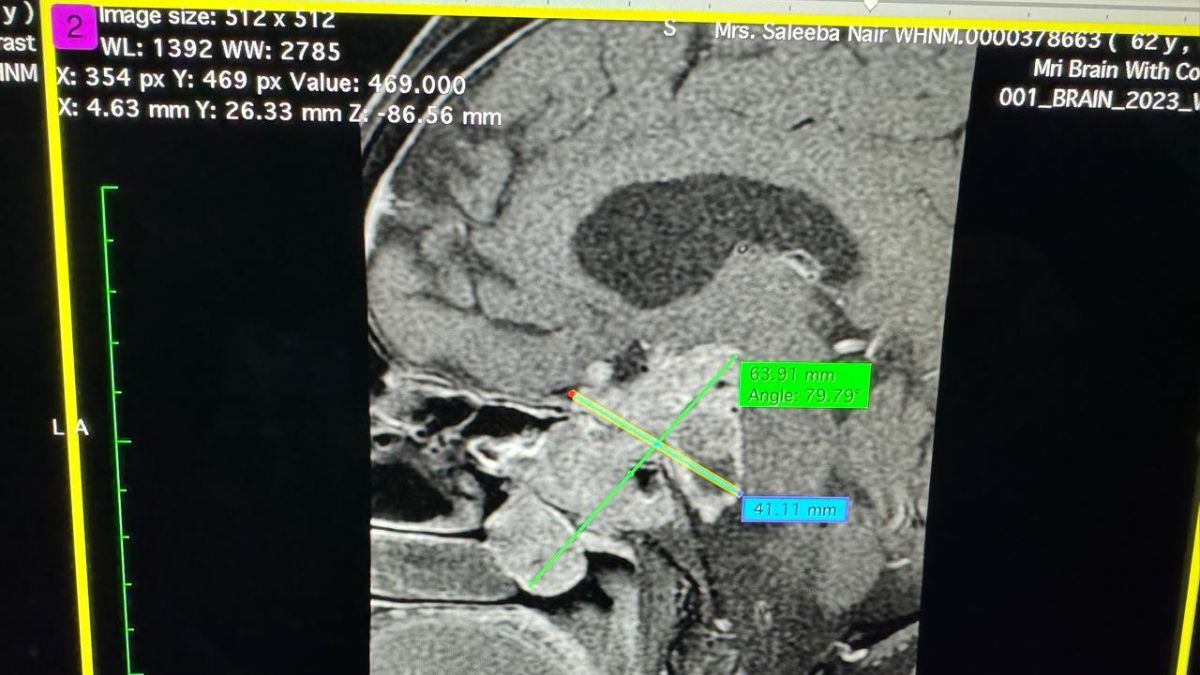 63-Year-Old Gets Miraculous Relief From Rare Largest Tumour On Her Pituitary Glands