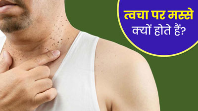 Skin Tags: त्वचा पर मस्से क्यों होते हैं? डॉक्टर से जानें कारण 