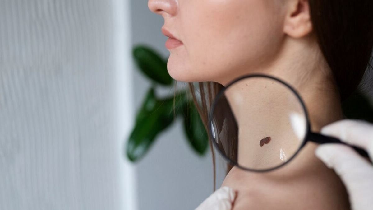 When Should You Start Worrying About A Mole?