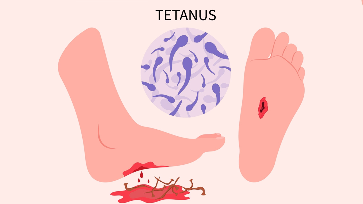 Tetanus Defence 101: How to Protect Yourself From This Serious Infection