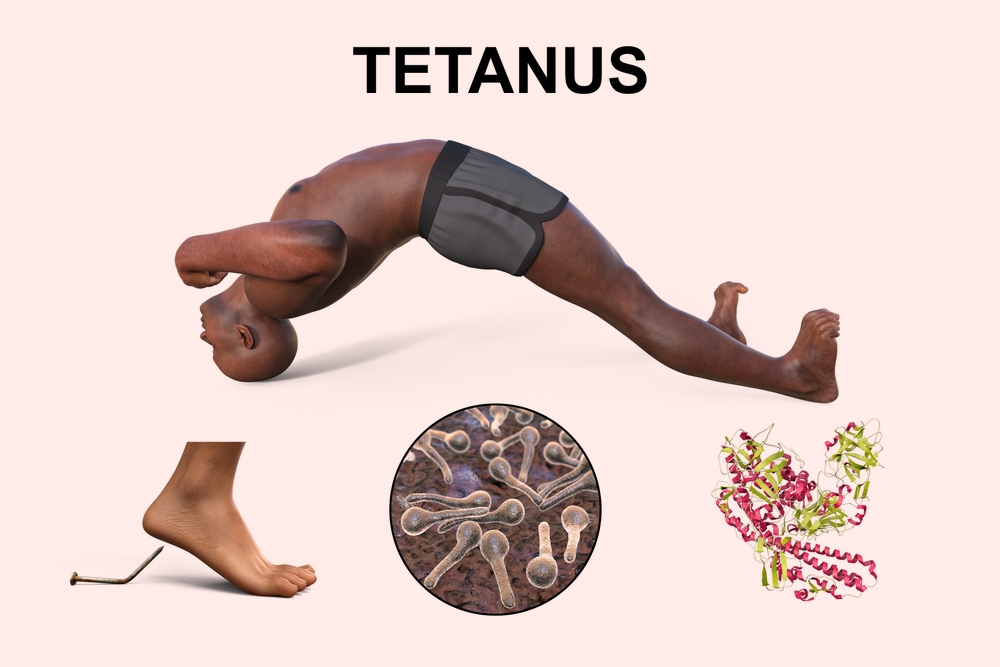 Tetanus Defence 101: How to Protect Yourself From This Serious ...