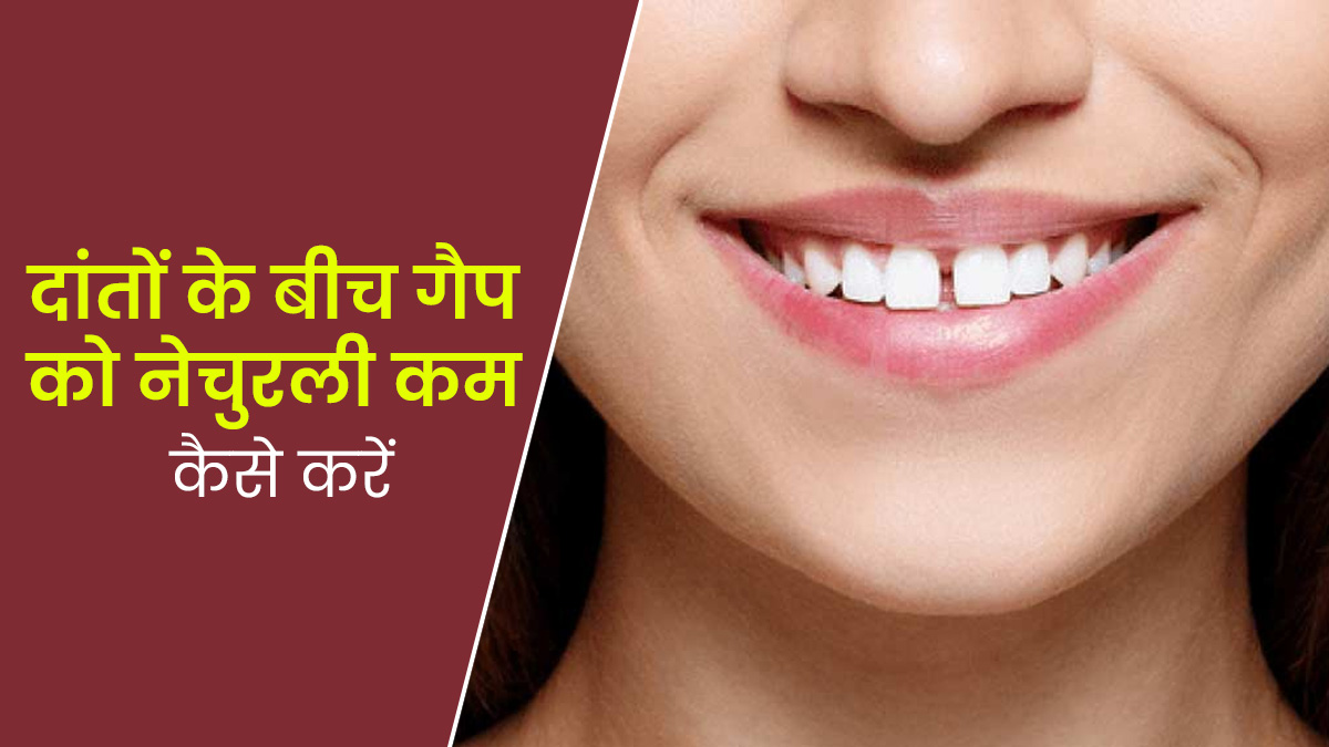 क्या आपके दांतों के बीच भी गैप है? जानें इस गैप को कम करने के लिए 4 टिप्स