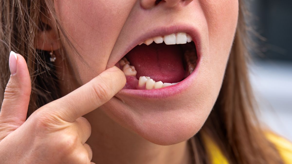 Here’s How Vitamin D Deficiency Can Cause Tooth Loss