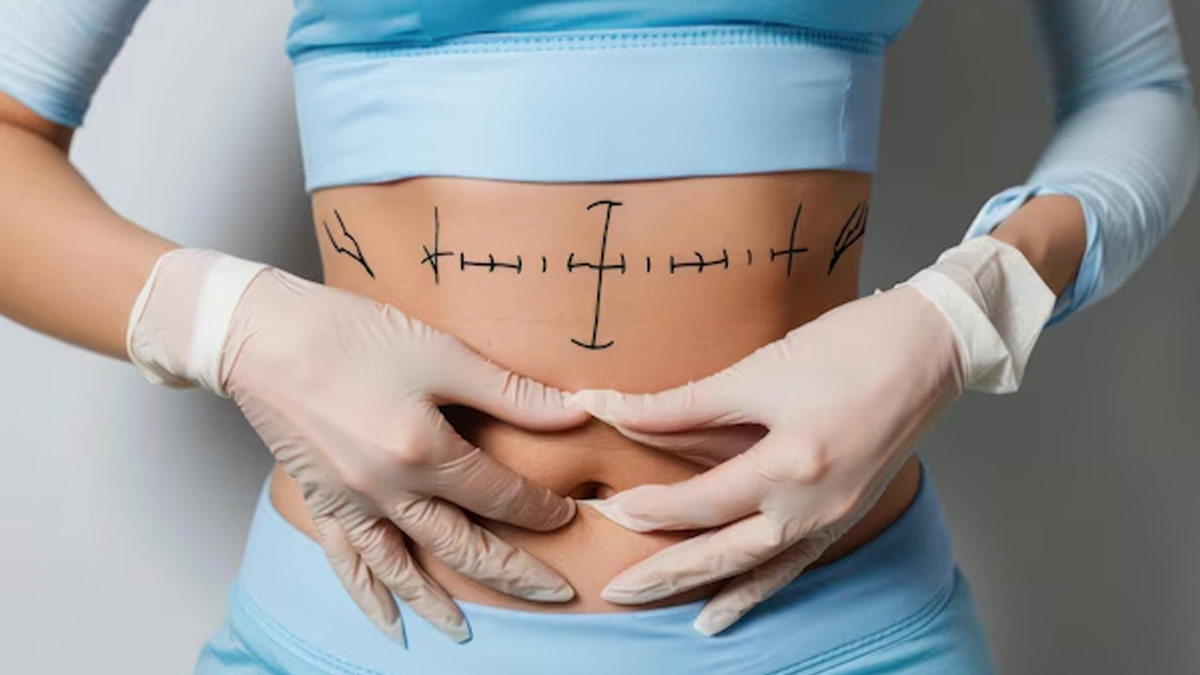 Body Contouring Surgery