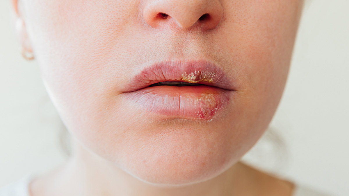 Cold Sores: Try These DIY Herbal Remedies To Promote Healing