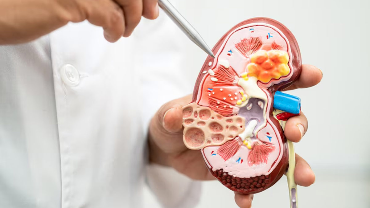 Living With Kidney Disease? Doctor Explains How To Manage Kidney Health Beyond Dialysis And Transplant