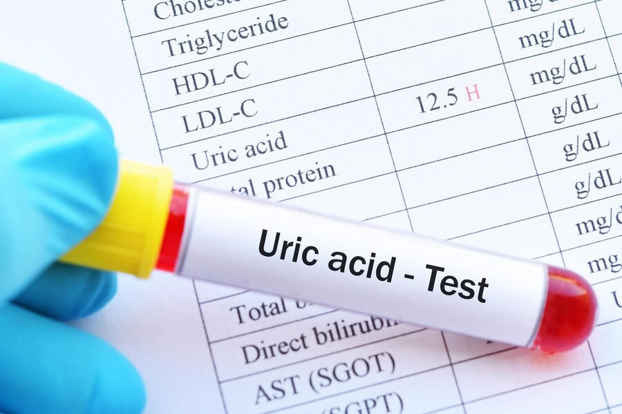 High-uric-acid