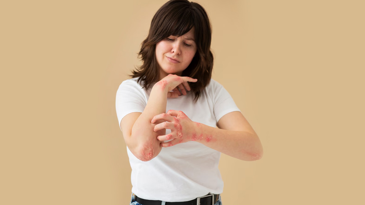 Coconut Oil For Eczema: Here's How It Can Help In Managing This Condition