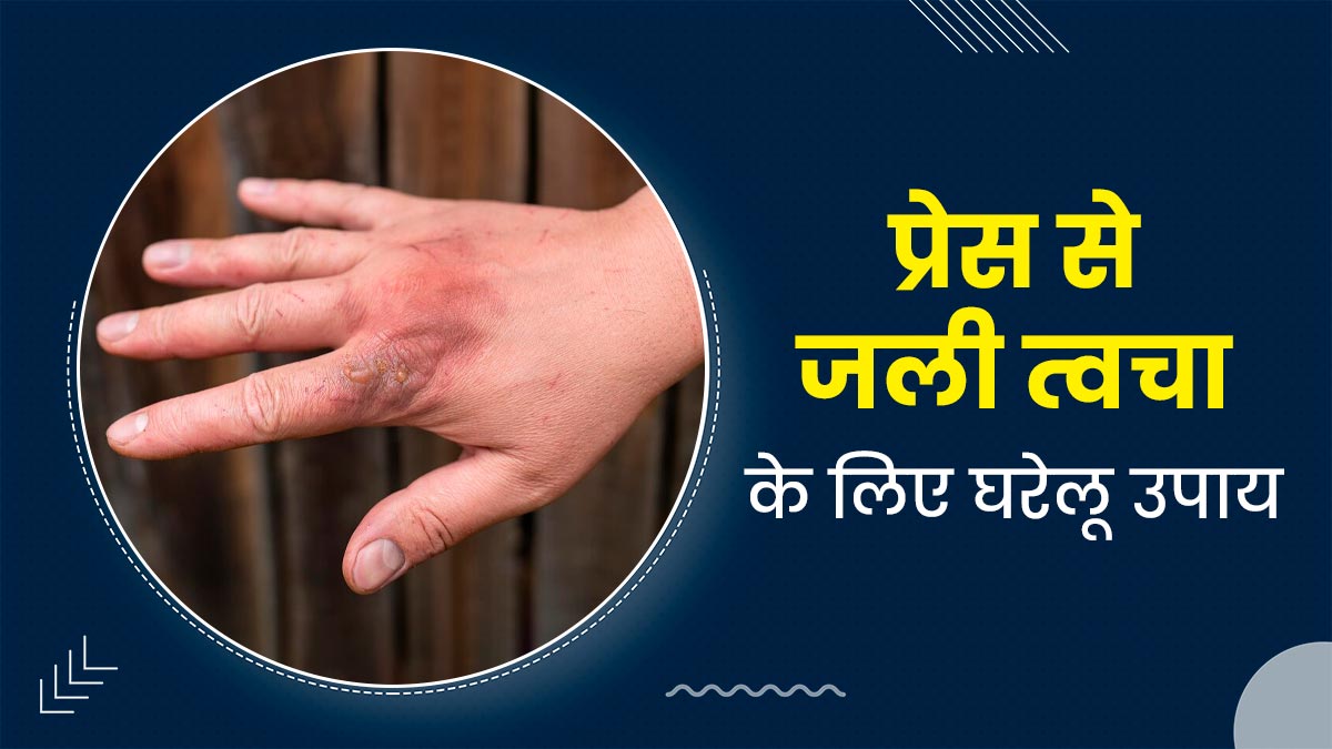गर्म प्रेस से जल जाए त्‍वचा, तो राहत के ल‍िए अपनाएं ये 9 घरेलू उपाय 