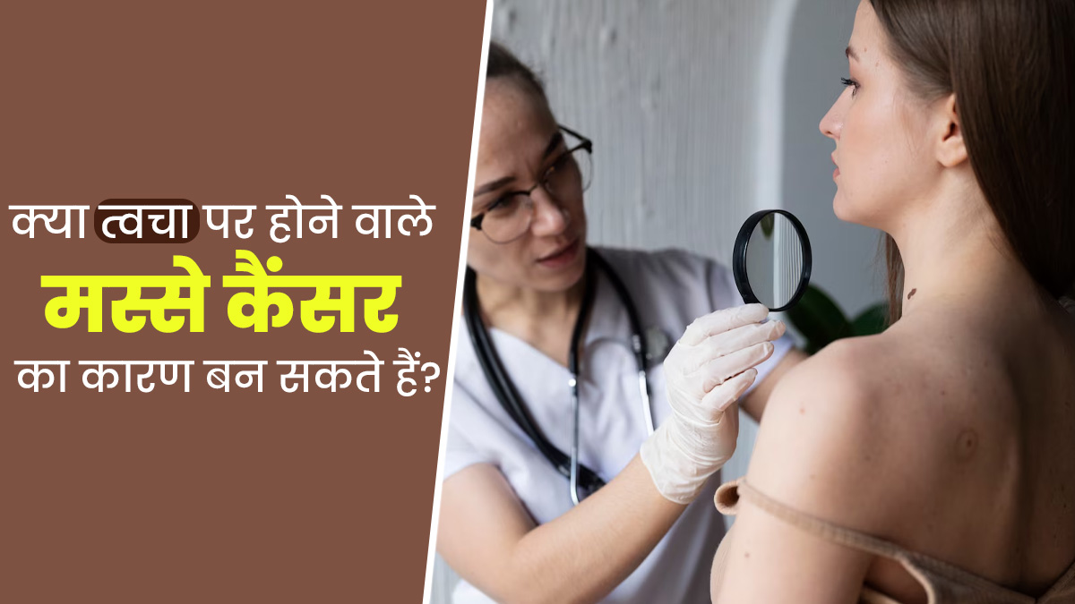 क्या त्वचा के मस्से कैंसर का कारण बन सकते हैं? डॉक्टर से जानें सच्चाई