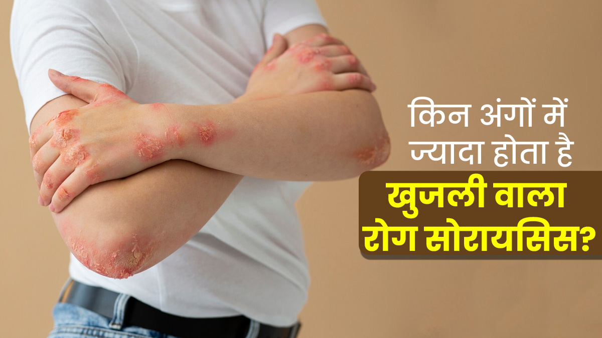 शरीर के किन अंगों में ज्यादा होता है खुजली वाला रोग सोरायसिस? डॉक्टर से जानें 