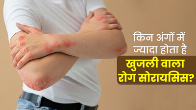 शरीर के किन अंगों में ज्यादा होता है खुजली वाला रोग सोरायसिस? डॉक्टर से जानें 