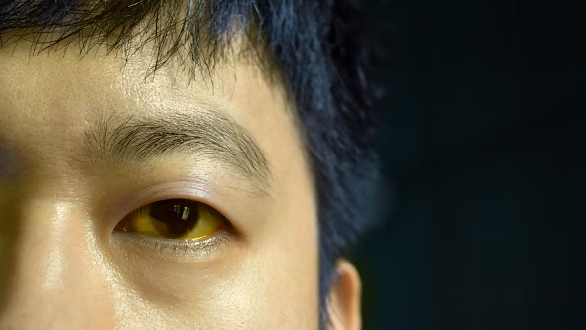 5 Causes Of Yellow Eyes That Go Beyond Jaundice | OnlyMyHealth, image size:1200x675