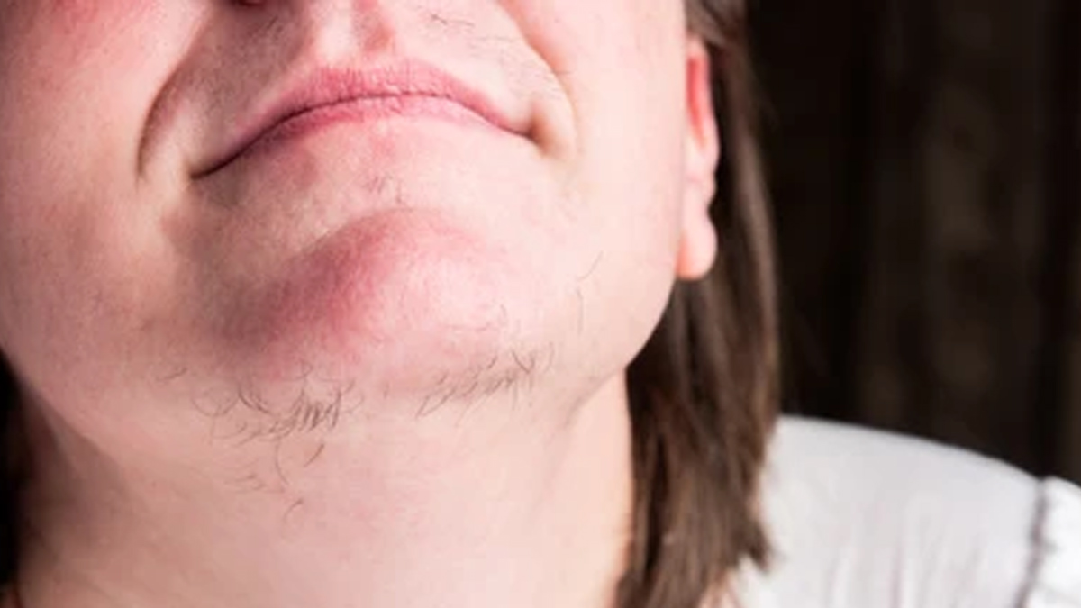 Is Your Facial Hair Increasing With Age? Expert Lists Causes | OnlyMyHealth