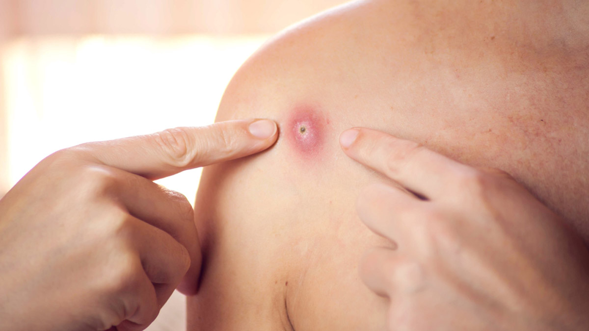 How To Differentiate Between A Pimple And A Boil: Know From A Dermatologist