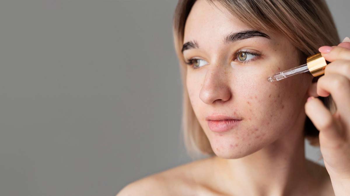 kojic acid benefits for acne